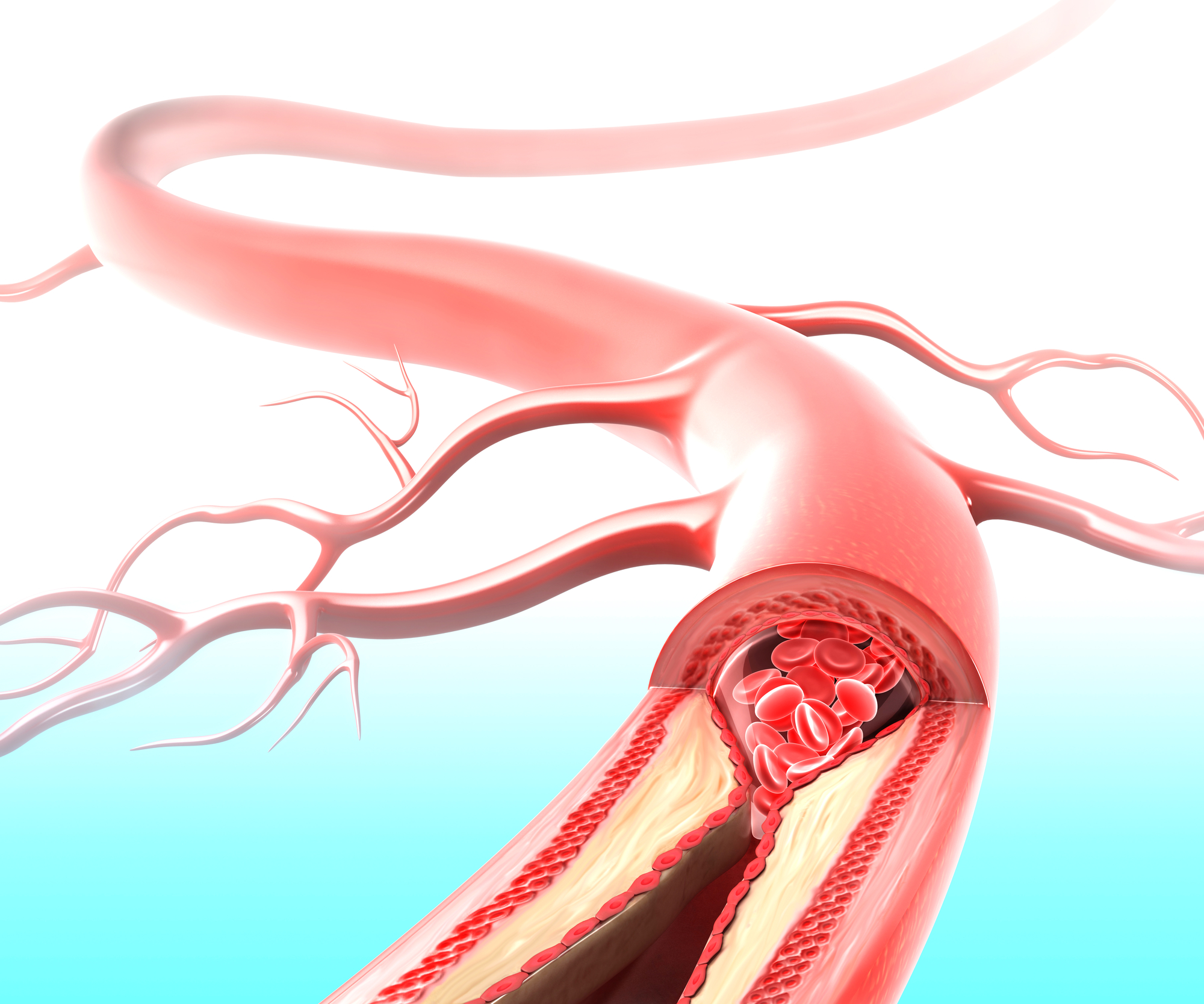 KAROTİS ARTER STENT UYGULAMASI.