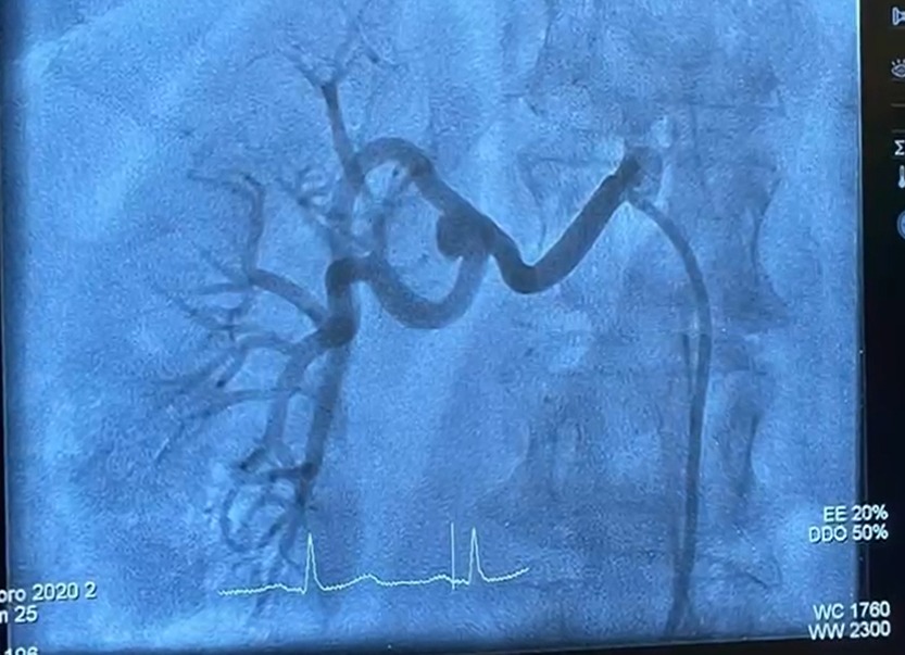 RENAL DENERVASYON