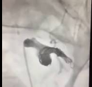 SESSİZ KATİL ANEVRİZMA