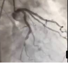 BYPASS ÖNERİLEN HASTAYI STENT İLE SAĞLIĞINA KAVUŞTURDUK.