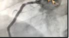 Bypass önerilen hastaya stent tedavisi ❤️💯